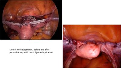 Laparoscopic Lateral Suspension (LLS) for the Treatment of Apical Prolapse: A New Gold Standard?